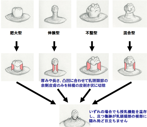 乳頭縮小術の形状分類による術式の一例
